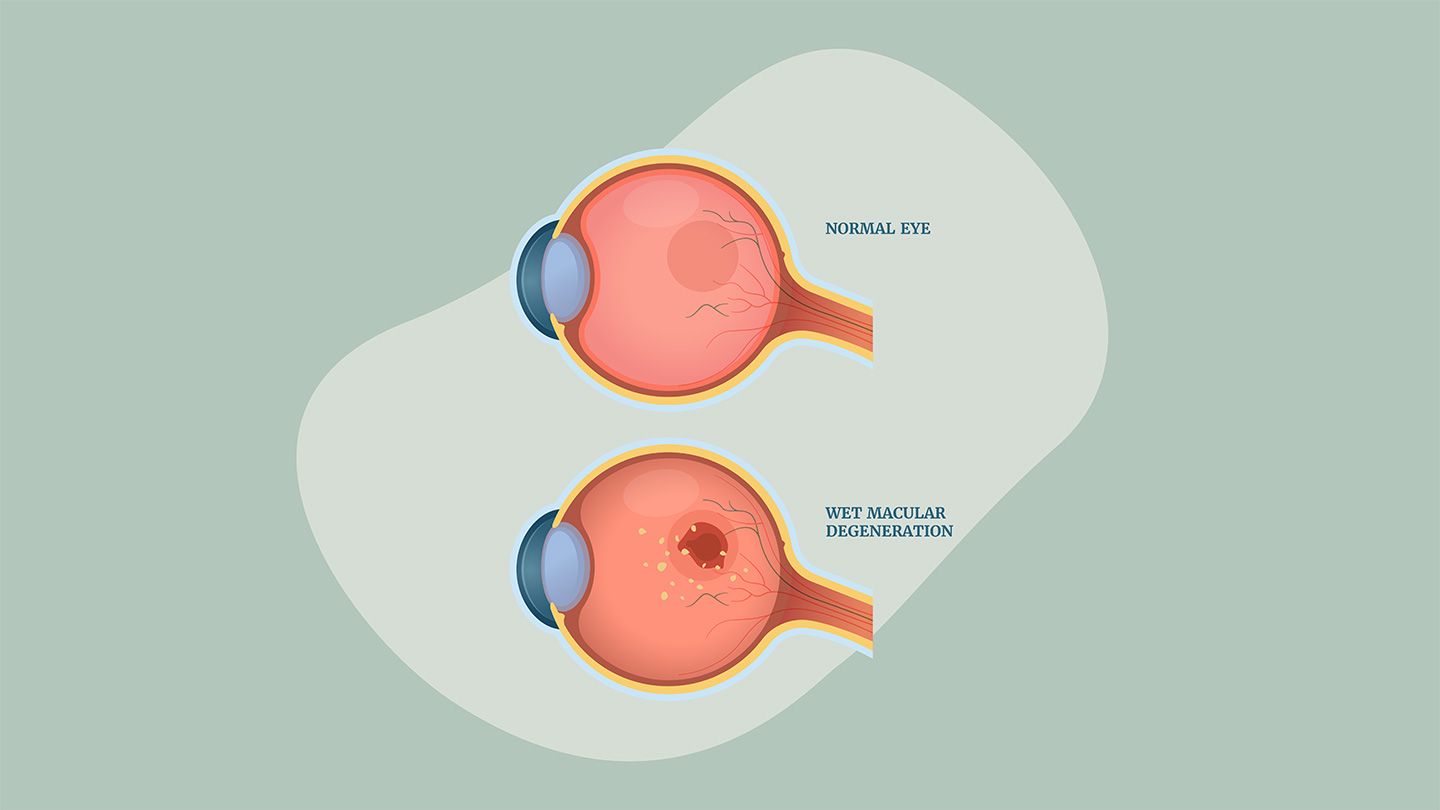 Effective Treatments for Age-Related Macular Degeneration