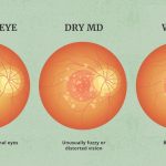 Living with Macular Degeneration: Effective Management Strategies