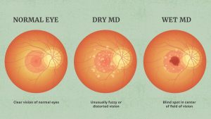 Living with Macular Degeneration: Effective Management Strategies