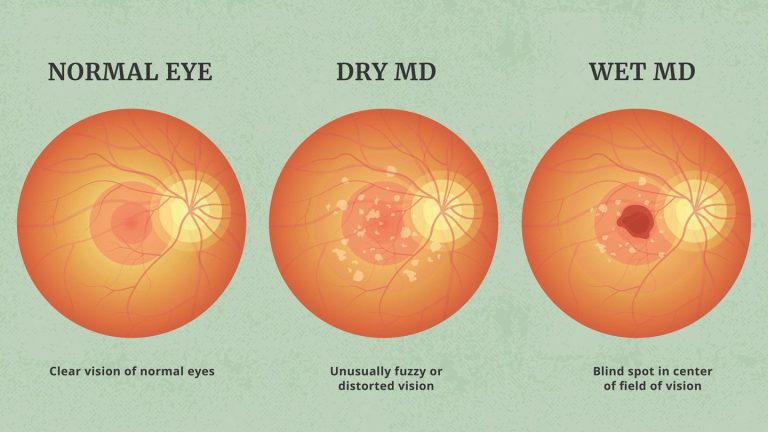 Living with Macular Degeneration: Effective Management Strategies